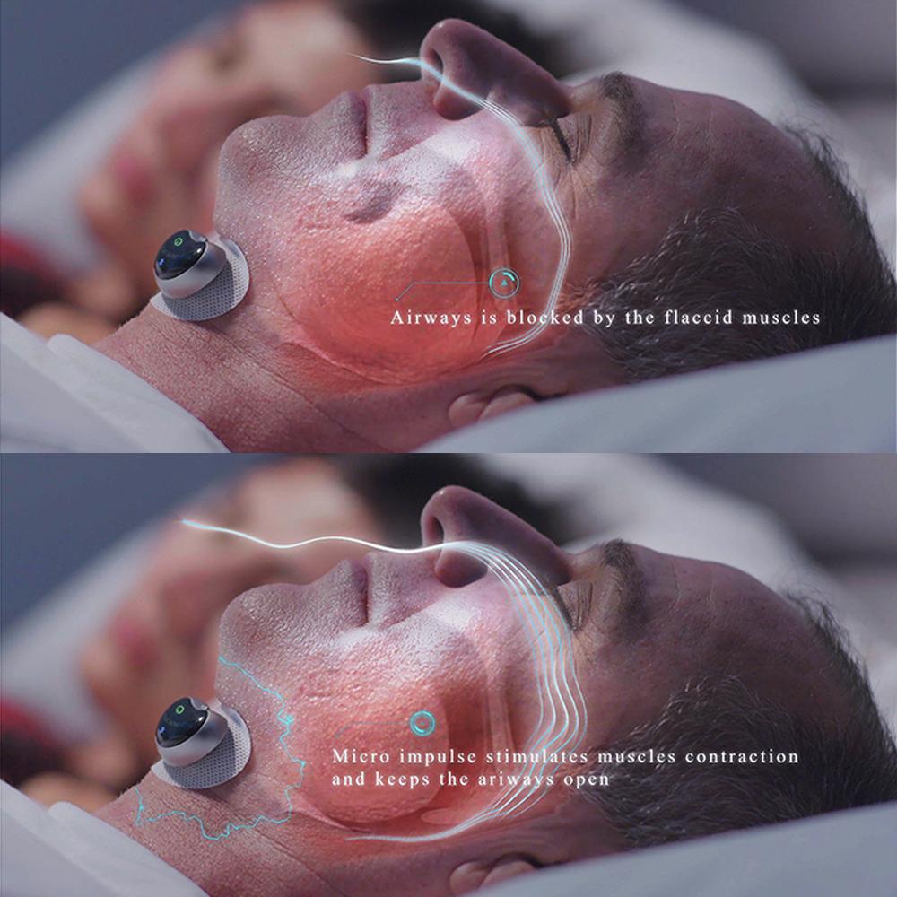 HexoSleep Smart Snore Stopper